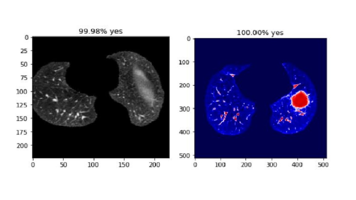 lung cancer detection using deep learning